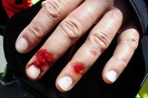 Verletzte Finger: Blutungen lassen sich eindämmen (Foto: D. Meinert, pixelio.de)