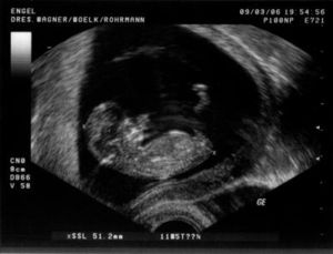 Ultraschallbild: Kinderwunsch lässt sich realisieren (Foto: pixelio.de/Der Arzt)