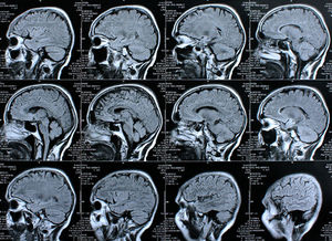 Gehirn-Scans: Neue Hypothese bei Parkinson aufgestellt (Foto: pixelio.de, Rike)