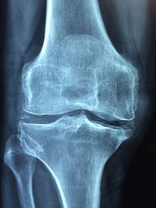 Röntgenbild: Knie oft von Arthrose betroffen (Foto: pixabay.com, Taokinesis)