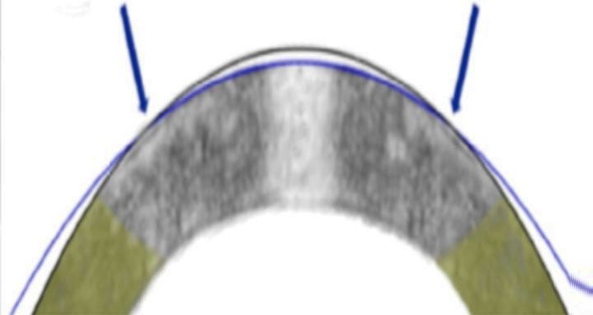 Augenkorrektur ist bald ohne Laser möglich