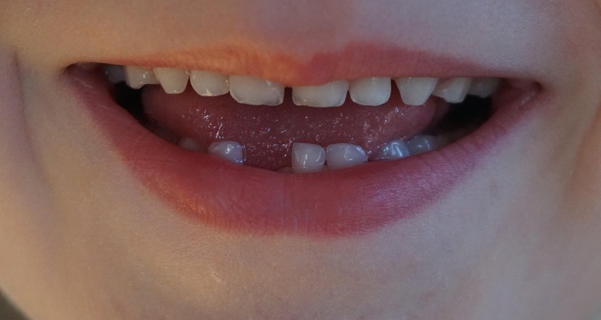 Gestresste Mütter: Milchzähne kommen früher