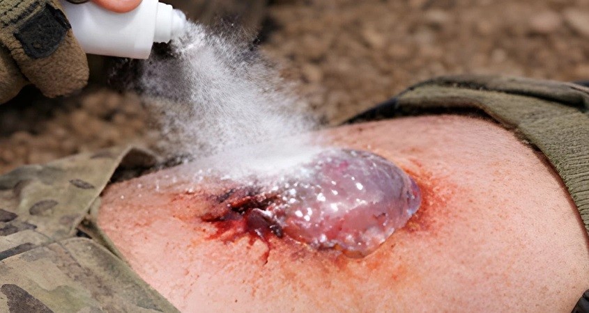 Hightech-Pulver stoppt Blutungen in Sekunden