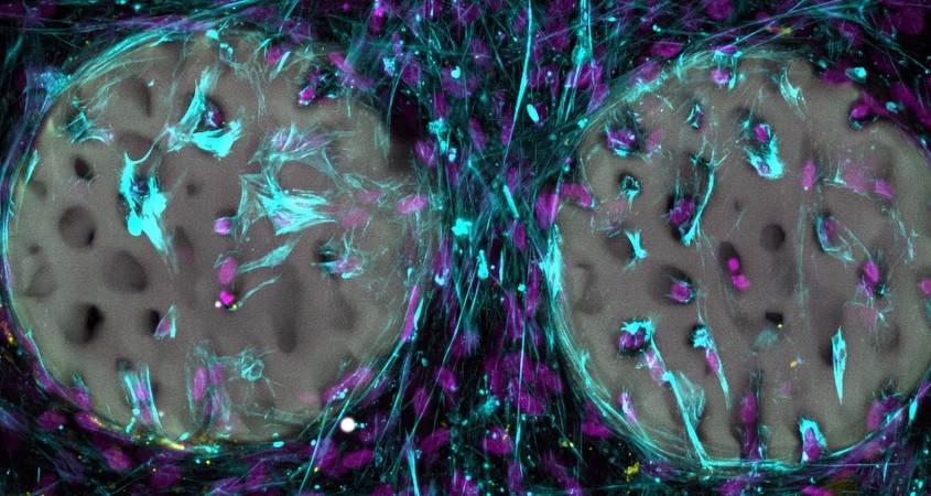 Hydrogel wird das Knochenimplantat der Zukunft