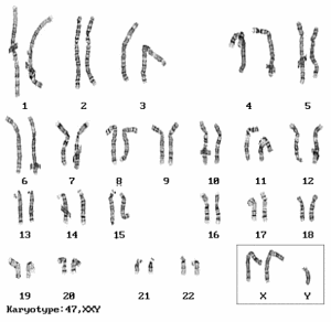 Bei KS kommt zum männlichen XY-Geschlechts-Chromosomensatz ein weiteres X-Chromosom dazu