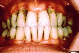Fortgeschrittene Periodontitis