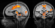 Die Hirnregionen PAG und Pons regulieren das Harnlassen (Bild: ukg/Baudewig)