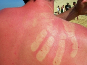 Hoher Lichschutzfaktor beugt Sonnenbrand vor, aber nicht Hautkrebs (Foto: pixelio.de, William Veder)