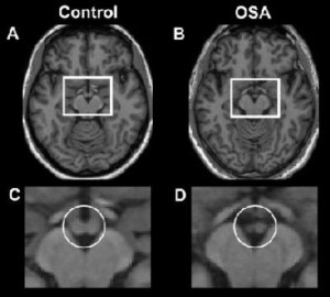Gehirnscan zeigt deutlich kleinere Mamillaren-Körper bei Apnoe-Patienten (rechts) (Foto: ucla.edu)