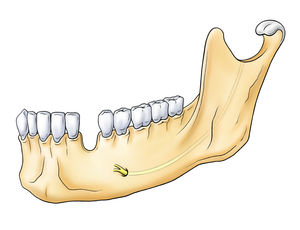 Typical tooth gap