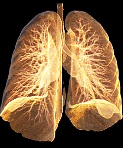 Lunge eines Rauchers, die bereits Vorzeichen eines Emphysems hat (Bild: University of Iowa)