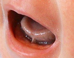 Ein zu kurzes Zungenbändchen (Bild) kann für Baby und Mutter zum Problem werden (Foto: Pietschnig)