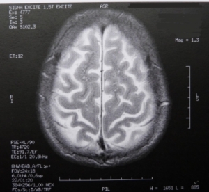 Gehirn: Herzindex beeinflusst Gesundheit von Gehirnzellen (Foto: pixelio.de/Dieter Schütz)