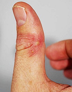 Neurodermitis: Beruflicher Kontakt mit Reizstoffen erhöht das Risiko (Foto: Wikimedia/Arne Borsum)