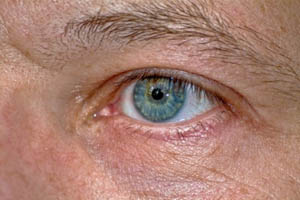 Auge: Bei Morbus Stargardt erblinden die Betroffenen (Foto: Templermeister/pixelio.de)