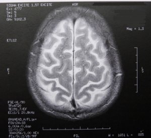 Gehirn-Scan: Neue Wege zur Früherkennung bei Alzheimer (Foto: Dieter Schütz/pixelio.de)