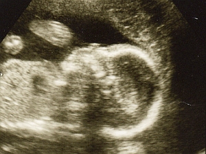 Ungeborenes Kind im Ultraschall: Behinderte noch immer diskriminiert (Foto: FlickrCC/Joefoodie) Ungeborenes Kind im Ultraschall: Behinderte noch immer diskriminiert (Foto: FlickrCC/Joefoodie)