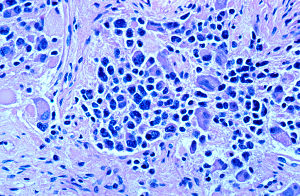 Neuroblastom-Zellen: Immuntherapie verbessert die Chancen (Foto: Wikimedia)