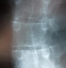 Wirbelsäule: Eigengewebe als Bandscheibenersatz (Foto: pixelio.de, D. Schütz) Wirbelsäule: Eigengewebe als Bandscheibenersatz (Foto: pixelio.de, D. Schütz)