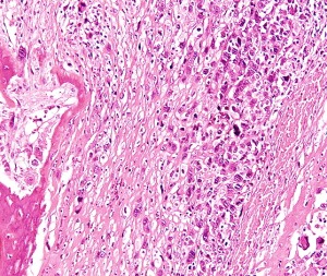 Knochenkrebs: Überlistung nach dem Troja-Vorbild möglich (Foto: Wikimedia) Knochenkrebs: Überlistung nach dem Troja-Vorbild möglich (Foto: Wikimedia)