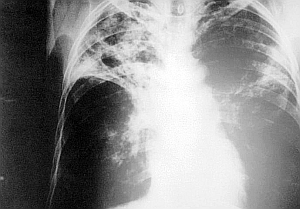 TB im Röntgen: Künftig reicht Batterie-betriebener Tester (Foto: Wikimedia)