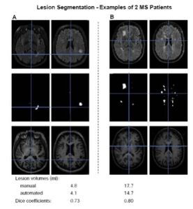 MRT-Bilder: Läsionsegmentierung bei zwei MS-Patienten (Grafik: M. Mühlau)