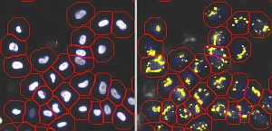 Neuroblastome: Rechts gelbe A-Beta-Plaques (Foto: Uni Ulm) Neuroblastome: Rechts gelbe A-Beta-Plaques (Foto: Uni Ulm)
