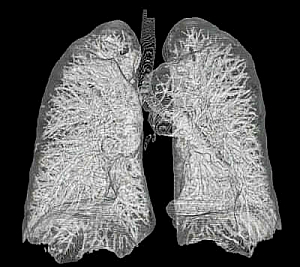 Lunge im CT: Organ oft beim Transport zerstört (Foto: Wikimedia/Heinemann) Lunge im CT: Organ oft beim Transport zerstört (Foto: Wikimedia/Heinemann)