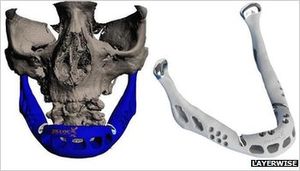 Künstlicher Kiefer: 3D-Technologie macht es möglich (Foto: http://layerwise.com)
