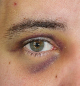 Blaues Auge: Lehman-Anleger können aufatmen (Foto: pixelio.de/Alexander Hauk)