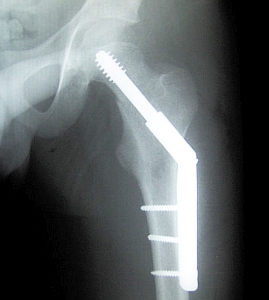 Hüftimplantat im Röntgen: Metall ist schlechtestes Material (Foto: Wikimedia)