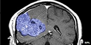 Tumor: Studie mit Hirnkrebs-Patienten zeigt neuen Ansatz (Foto: SPL)