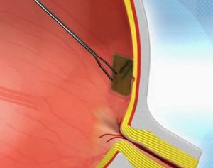 Augenimplantat: auf Retina angebracht (Foto: optics.org)
