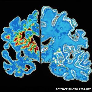 Gehirn: Gewebe wird irreparabel geschädigt (Foto: Science Photo Library)