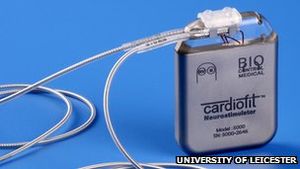 Implantat: Cardiofit soll Herz auf die Sprünge helfen (Foto: le.ac.uk) Implantat: Cardiofit soll Herz auf die Sprünge helfen (Foto: le.ac.uk)