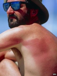 Sonnenbrand: Kinder halten Rötungen für ungefährlich (Foto: SPL) Sonnenbrand: Kinder halten Rötungen für ungefährlich (Foto: SPL)