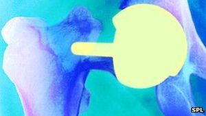 Oberflächenersatz: nur Teile werden ersetzt (Foto: SPL) Oberflächenersatz: nur Teile werden ersetzt (Foto: SPL)