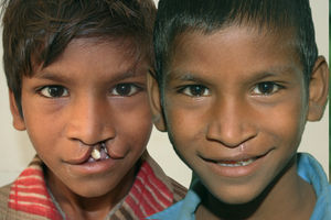 Ranjit aus Indien (Foto: Deutsche Cleft Kinderhilfe e.V.)