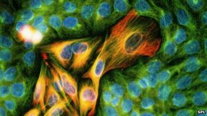 Melanome: Krebs wird von Medikament abhängig (Foto: SPL)