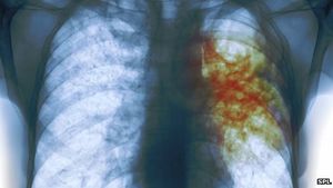 Lunge mit Tuberkulose: Körper reagiert häufig falsch (Foto: SPL)