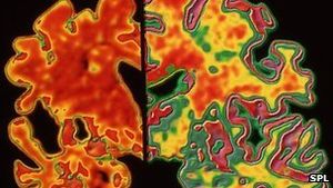 Gehirn-Scan: Veränderungen durch Alzheimer werden sichtbar (Foto: SPL)