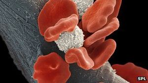 Leukämie: Forscher machen Hoffnung auf neue Medikamente (Foto: SPL) Leukämie: Forscher machen Hoffnung auf neue Medikamente (Foto: SPL)