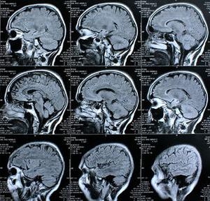 Gehirnscans: Forscher wollen Funktion klären (Foto: pixelio.de, Rike)
