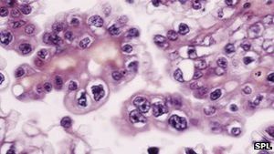 Eierstockkrebs: Frühe Diagnose kann Leben von Frauen retten (Foto: SPL)