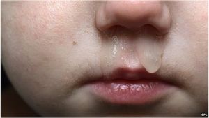 Schwerer Schnupfen: Antibiotika oft jedoch überflüssig (Foto: SPL)