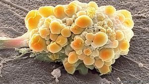 Gehirntumor: Neuer Behandlungsansatz gibt Hoffnung (Foto: SPL)