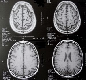 Gehirnscans: Forscher wollen Demenz bekämpfen (Foto: pixelio.de, Dieter Schütz)