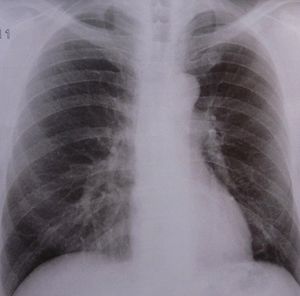 Lungen-Röntgen: Tuberkulose-Resistenzen nehmen zu (Foto: pixelio.de, D. Schütz)