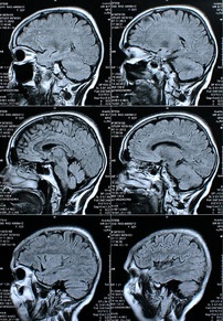 Gehirne im Querschnitt: Informationsfluss kompliziert (Foto: pixelio.de, Rike)