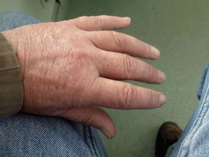 Hand: Forscher ergründen Psoriasis-Arthritis (Foto: J. Sawluk/pixelio.de)